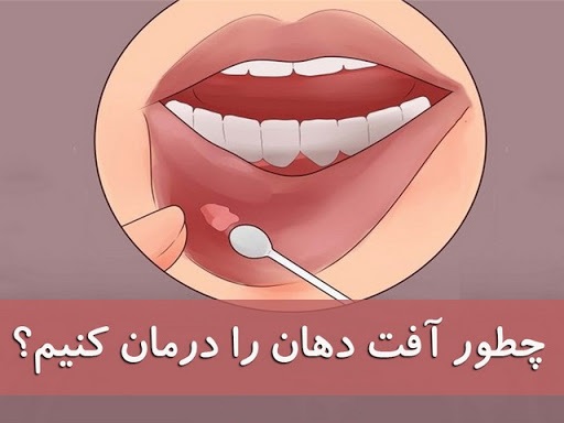 خداحافظی با آفت دهان در 24 ساعت